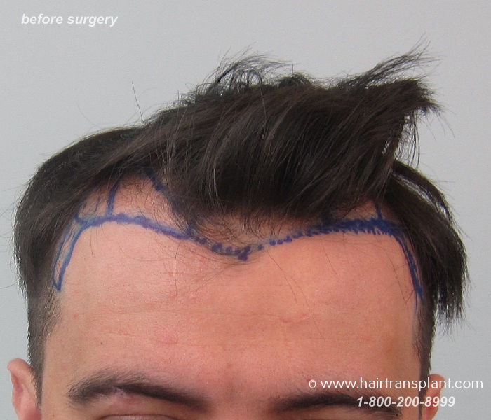 Crown Hair Transplant in Mexico