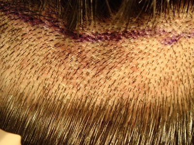 Hair Transplant Results After 1 Year | Hair Restoration Results & Images