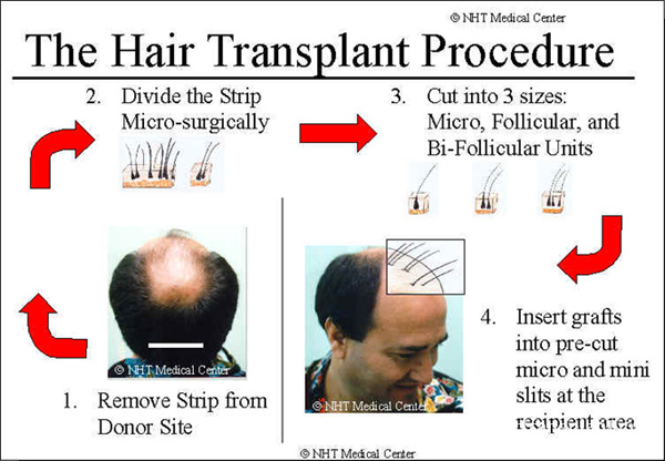 Hair transplant procedure - Hair Transplant